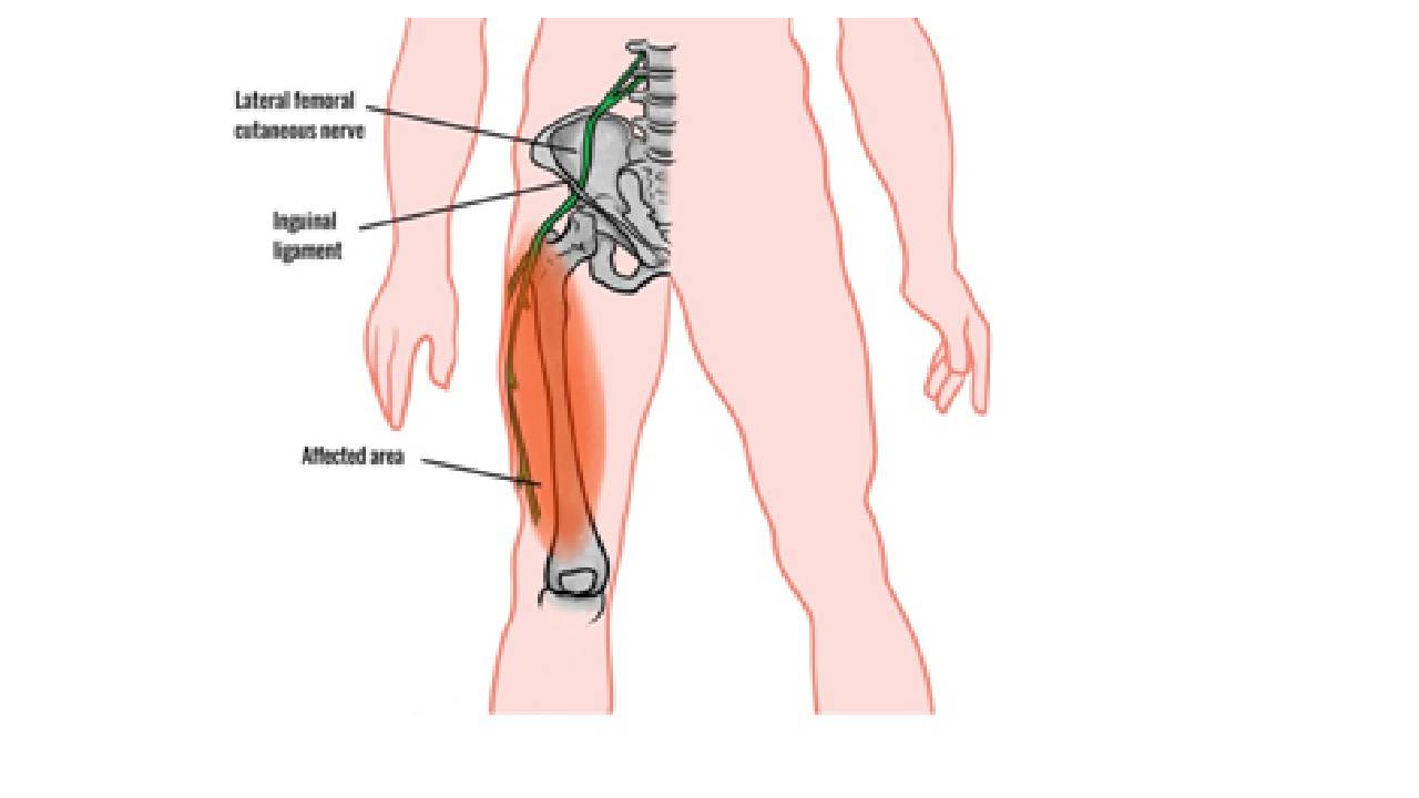 If you have irritating outer thigh so you should know about this